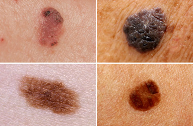 melanoma